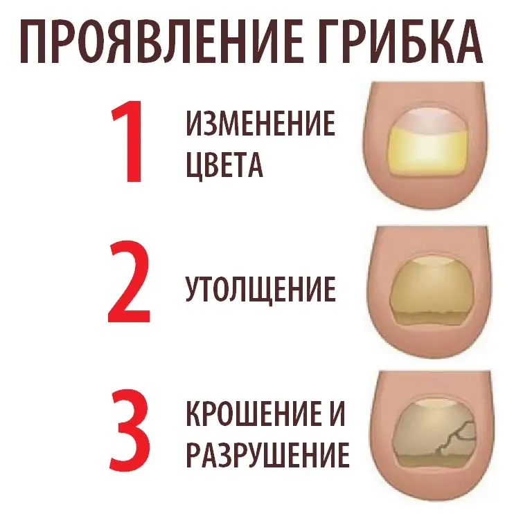 Лечение грибка ногтей (онихомикоз)